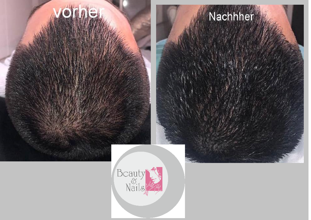 Microhaarpigmentierung